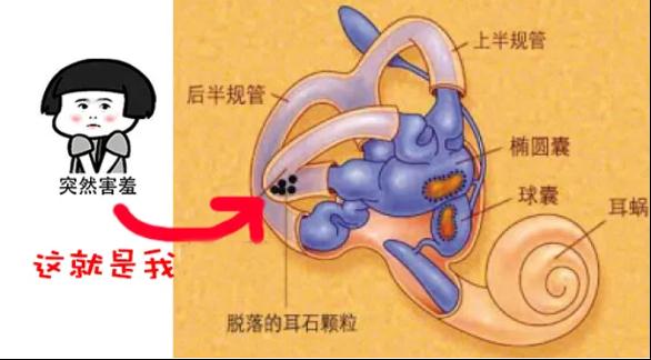 90后小伙睡醒后突然头晕呕吐！原来是这些“小石头”跑偏了